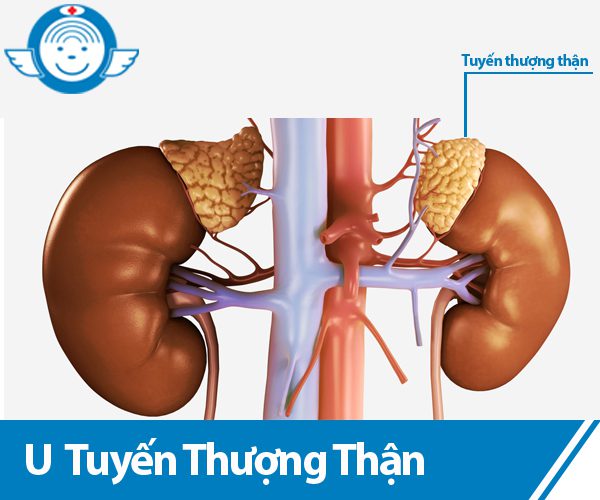 U tuyến thượng thận - Hình ảnh minh họa